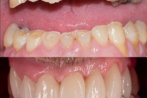 Tooth Wear Treatment in Jaipur – Expert Care at Olivegreen Dental Clinic