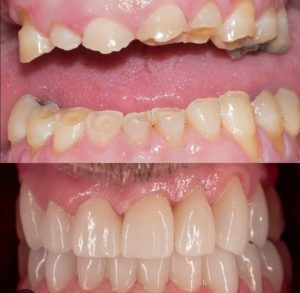 Tooth Wear Treatment in Jaipur – Expert Care at Olivegreen Dental Clinic