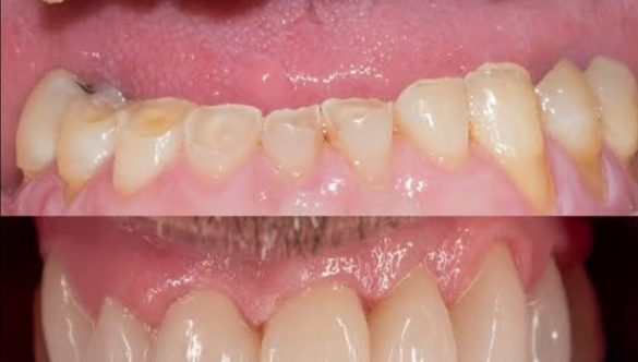 Tooth Wear Treatment in Jaipur – Expert Care at Olivegreen Dental Clinic