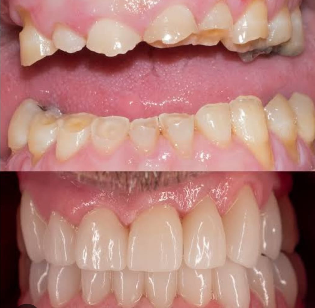 Tooth Wear Treatment in Jaipur – Expert Care at Olivegreen Dental Clinic