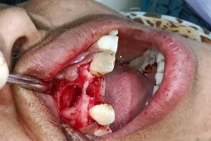 Case Presentation: Successful Cyst Enucleation at Olivegreen Dental Clinic