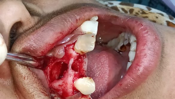 Case Presentation: Successful Cyst Enucleation at Olivegreen Dental Clinic