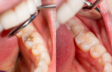 Dental Fillings
