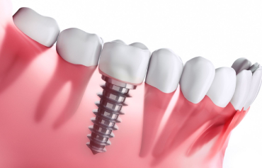 Dental Implant