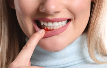 Gum Disease Treatment