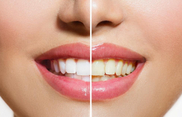 Teeth Whitening